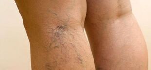 Varices en las piernas. 
